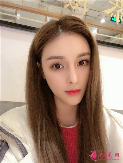 重慶耳軟骨隆鼻術(shù)后恢復(fù)效果分享 術(shù)后 重慶耳軟骨隆鼻術(shù)后恢復(fù)效果分享