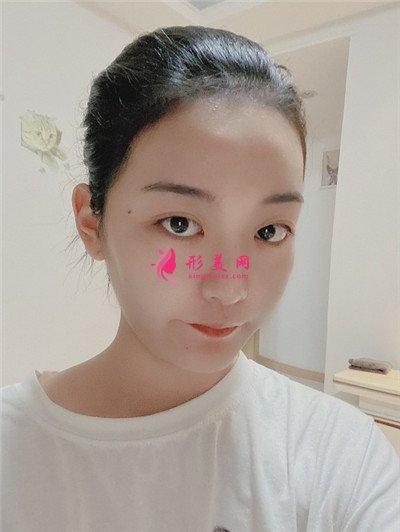 杭州發(fā)際線調(diào)整術(shù)后恢復效果對比 術(shù)后 杭州發(fā)際線調(diào)整術(shù)后恢復效果對比