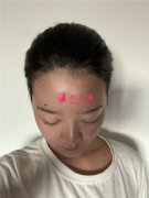 杭州同榮麗格醫(yī)療美容發(fā)際線調(diào)整術后恢復效果對比