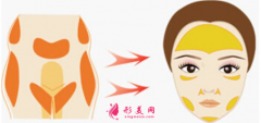 自體脂肪填充臉部脂肪存活率跟什么有關？