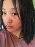 杭州華山連天美醫(yī)療美容醫(yī)院面部埋線提升術后恢復情況分析
