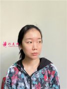 蘇州美貝爾美容醫(yī)院小姐姐全切雙眼皮術后效果對比