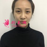 自體脂肪活細胞除皺真實體驗分享