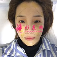 自體脂肪活細胞除皺真實體驗分享