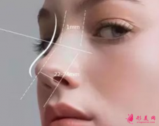 假體隆鼻恢復期要多久？
