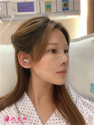廣州耳軟骨隆鼻術后恢復情況對比