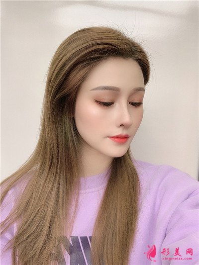 廣州耳軟骨隆鼻術后恢復情況對比 術后 廣州耳軟骨隆鼻術后恢復情況對比