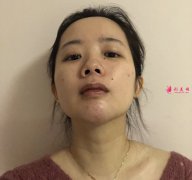深圳富華隆鼻好不好？真人案例隆鼻110天前后對比圖分享