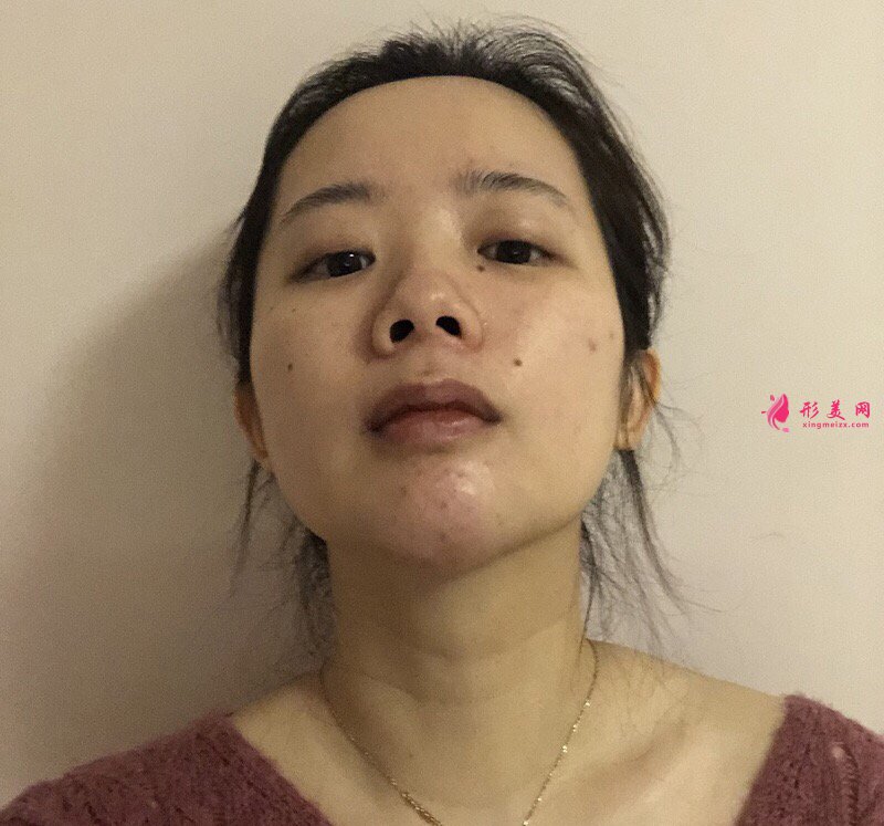 深圳富華曹夢(mèng)君醫(yī)師真人案例 隆鼻110天前后對(duì)比圖分享