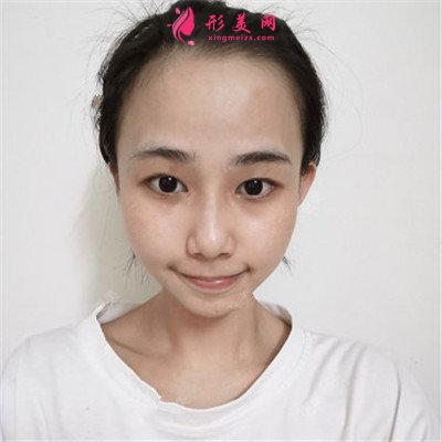 武漢小仙女眼部綜合術(shù)后恢復(fù)情況分享