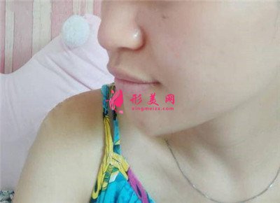 南昌假體隆鼻術(shù)后恢復(fù)情況對比