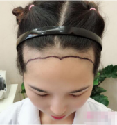 上海大麥微針植發(fā)哪里好？華美植發(fā)際線價(jià)格貴不貴，術(shù)后案例分享