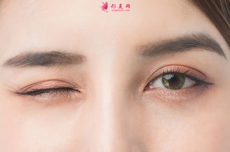 雙眼皮手術(shù)價格大概要多少錢