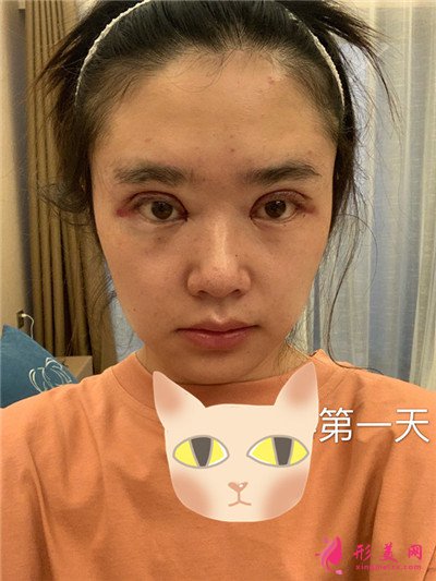 南寧全切雙眼皮術后恢復情況對比圖分享