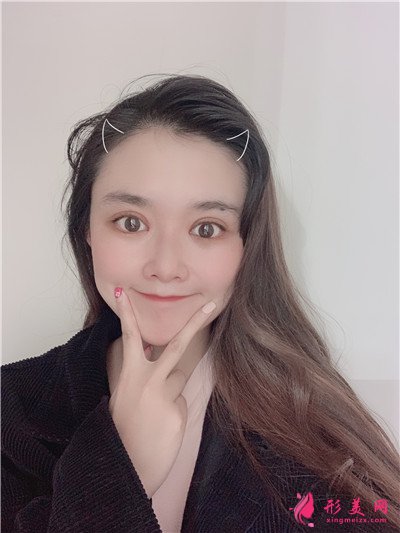 南寧全切雙眼皮術后恢復情況對比圖分享 術后 南寧全切雙眼皮術后恢復情況對比圖分享