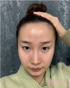 成都恒博植發(fā)發(fā)際線植發(fā)貴不貴？案例效果一覽