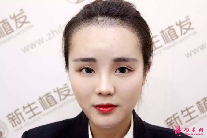 杭州新生植發(fā)價格表。附植發(fā)案例