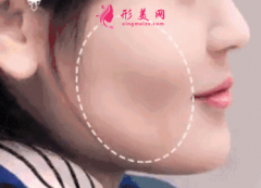 自體脂肪填充臉部一般要注射幾次？