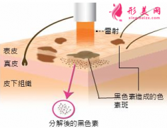 激光祛斑術(shù)后怎么做護理