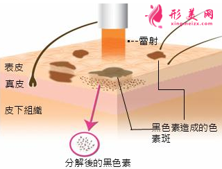 激光祛斑術(shù)后怎么做護(hù)理
