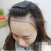 北京煤炭總醫(yī)院小姐姐發(fā)際線調(diào)整手術(shù)案例對比圖