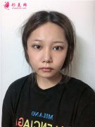 杭州華山連天美醫(yī)療美容醫(yī)院面部線雕術(shù)后恢復(fù)情況反饋