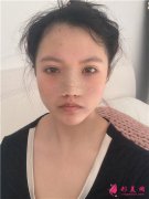 深圳藝星醫(yī)療美容醫(yī)院耳軟骨隆鼻術(shù)后恢復(fù)情況對比案例分享
