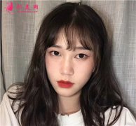 杭州華山連天美醫(yī)療美容醫(yī)院小仙女全切雙眼皮手術(shù)術(shù)后效果分享