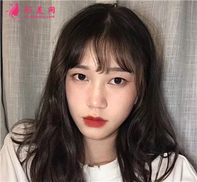 杭州小仙女全切雙眼皮手術(shù)術(shù)后效果分享