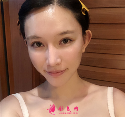 成都吸脂瘦臉術(shù)后效果對比，小姐姐的臉型好看了很多