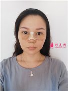 廣州廣大整形美容醫(yī)院小姐姐鼻綜合手術(shù)術(shù)后效果展示