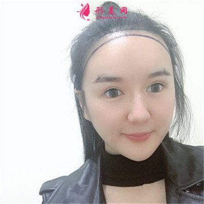 廣州植發(fā)際線手術(shù)術(shù)后效果展示
