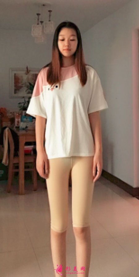 重慶美圣美邦醫(yī)療美容整形吸脂瘦大腿案例