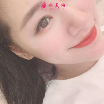 長(zhǎng)虹醫(yī)療分享光子嫩膚真實(shí)案例 術(shù)后94天效果圖