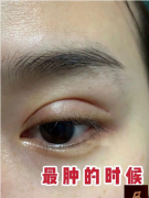 上海華美整形做的雙眼皮，手術(shù)后四個(gè)月超自然