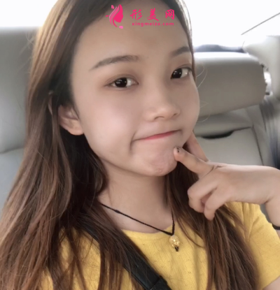 洛陽維美陳海濤做的雙眼皮 95天后效果真的很好