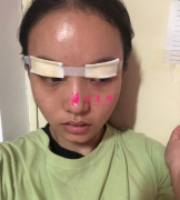 四川華人醫(yī)聯(lián)整形美容醫(yī)院的雙眼皮，95天后效果真的很好