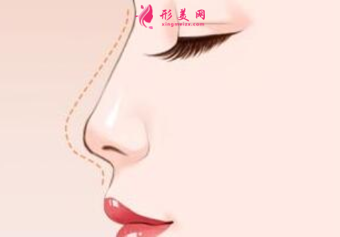 自體軟骨隆鼻效果好不好呢