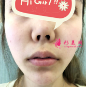 鄭州締萊美醫(yī)療美容醫(yī)院厚唇改薄M唇案例分享 嘟嘟M唇我很喜歡