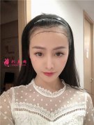 廣州植發(fā)要多少錢一般，小姐姐發(fā)際線種植手術(shù)術(shù)后效果反饋