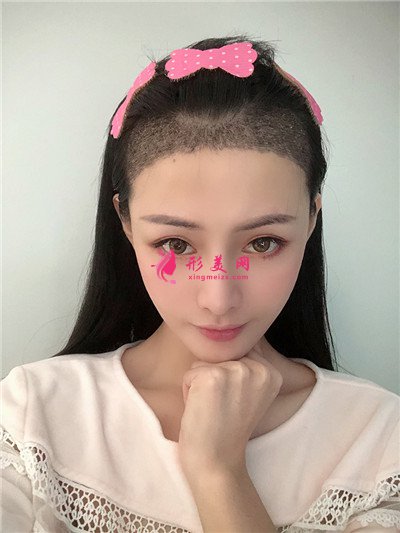 廣州小姐姐發(fā)際線種植手術(shù)術(shù)后效果反饋 術(shù)后 廣州小姐姐發(fā)際線種植手術(shù)術(shù)后效果反饋