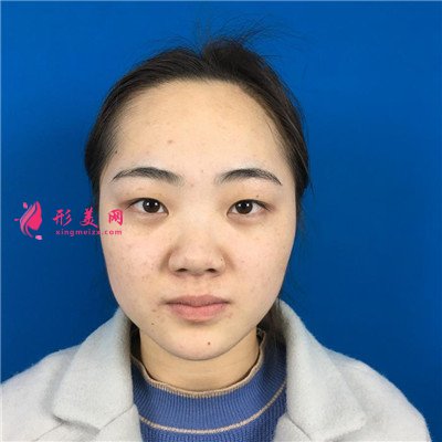 南昌眼部綜合手術(shù)術(shù)后效果反饋