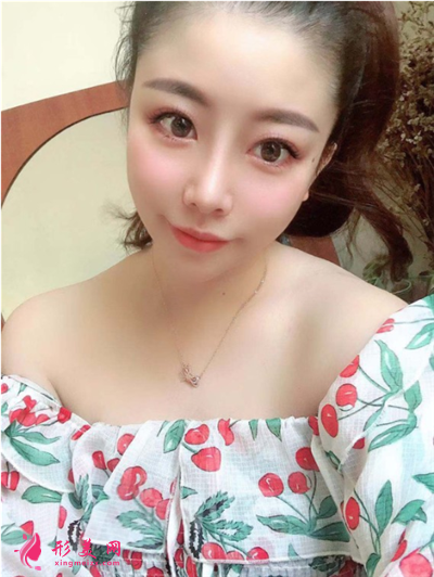 成都鼻綜合手術(shù)術(shù)后恢復(fù)情況對(duì)比 術(shù)后 成都鼻綜合手術(shù)術(shù)后恢復(fù)情況對(duì)比