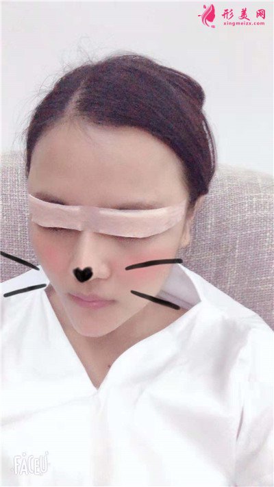 南寧小姐姐全切雙眼皮手術術后恢復情況對比