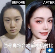 蘇州美貝爾童列健醫(yī)生怎么樣？鼻綜合案例術(shù)后2個月分享