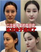 上海九院王濤隆鼻修復(fù)案例！告別鼻背透光問題