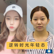 北京潤美玉之光王明利吸脂面部填充脂肪案例
