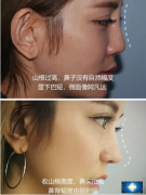 重慶西南醫(yī)院做鼻修復(fù)效果好不好？初鼻兩年后做的修復(fù)效果