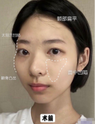 上海九院做面部填充效果好不好？花了不到2萬高顴骨不見了