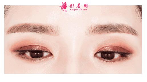 切開(kāi)雙眼皮多久變得自然